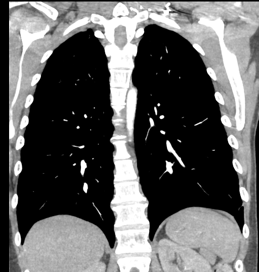 File:Aortic valve non-coronary cusp thrombus (Radiopaedia 55661-62189 C 55).png