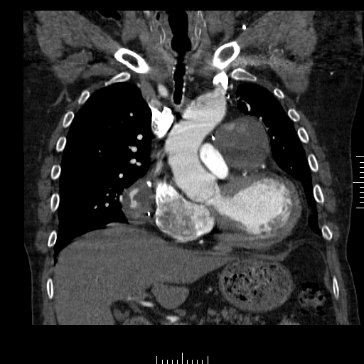 File:Aorto-coronary bypass graft aneurysms (Radiopaedia 40562-43157 B 17).png