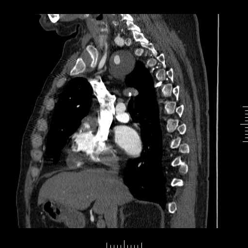 File:Aorto-coronary bypass graft aneurysms (Radiopaedia 40562-43157 C 12).png