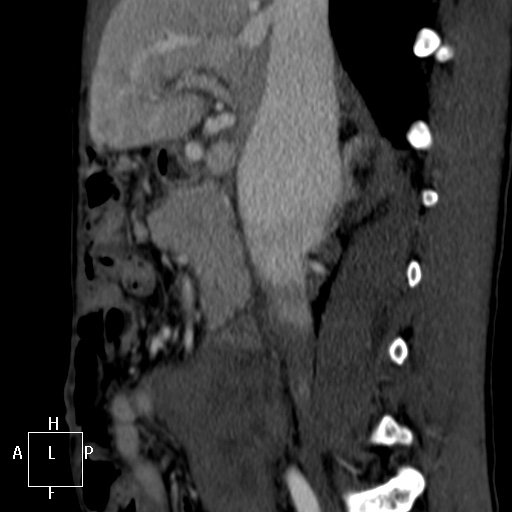 Aorto-left renal vein fistula (Radiopaedia 45534-49628 C 20).jpg