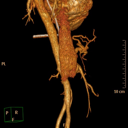 File:Aorto-left renal vein fistula (Radiopaedia 45534-49628 D 22).jpg