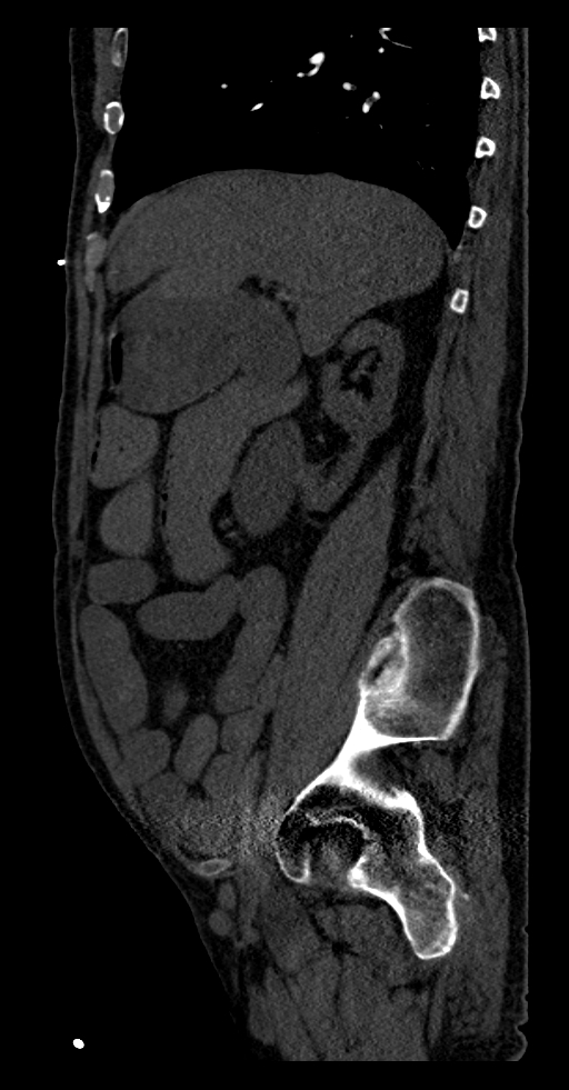 Aortoduodenal fistula (Radiopaedia 75286-86415 F 48).jpg