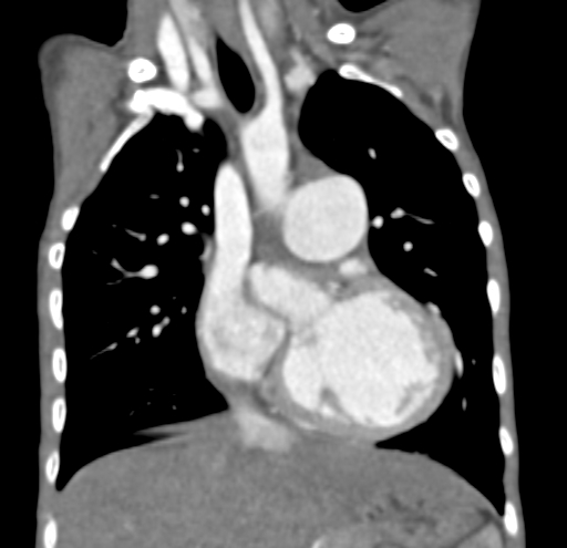 File:Aortopulmonary window, interrupted aortic arch and large PDA giving the descending aorta (Radiopaedia 35573-37074 D 29).jpg