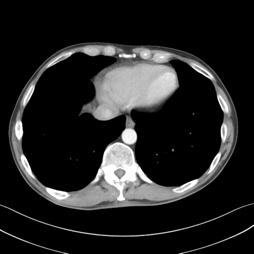 Apical pleural calcification (Radiopaedia 46141-50499 Axial C+ delayed 55).png