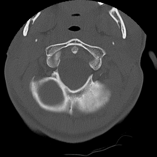 Apical pneumothorax on cervical spine CT (Radiopaedia 45343-49368 Axial bone window 10).jpg