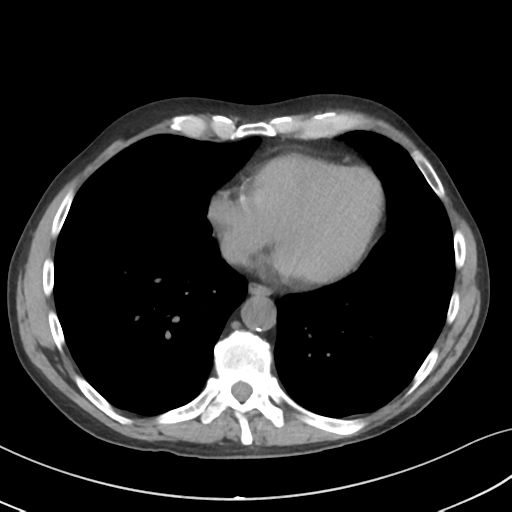 Apical pulmonary metastasis (Radiopaedia 46338-50754 B 44).png