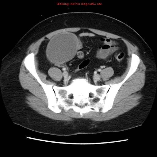 Appendiceal mucinous cystadenoma (Radiopaedia 8263-9111 Axial liver window 61).jpg