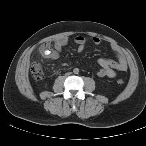Appendicitis and giant appendicolith (Radiopaedia 80251-93588 Axial non-contrast 32).jpg