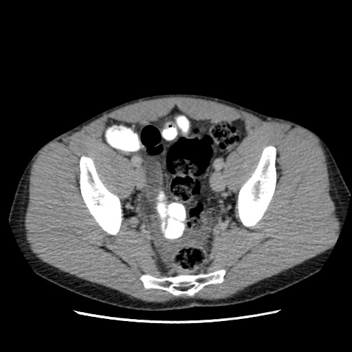 File:Appendicitis complicated by post-operative collection (Radiopaedia 35595-37113 A 65).jpg