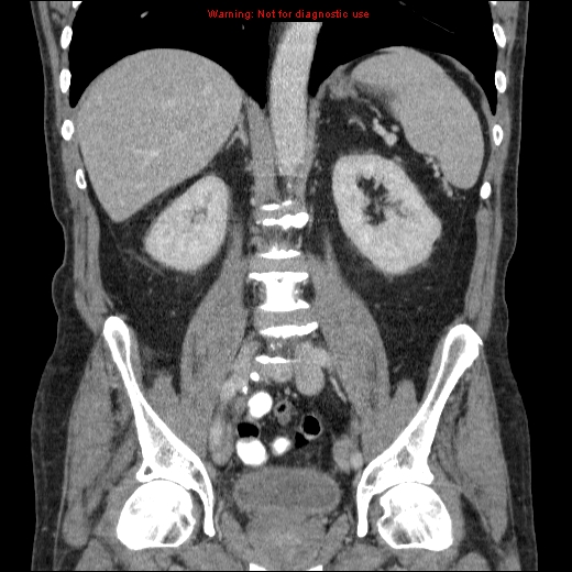 File:Appendicitis mass in inguinal hernia (Radiopaedia 26858-27029 B 45).jpg