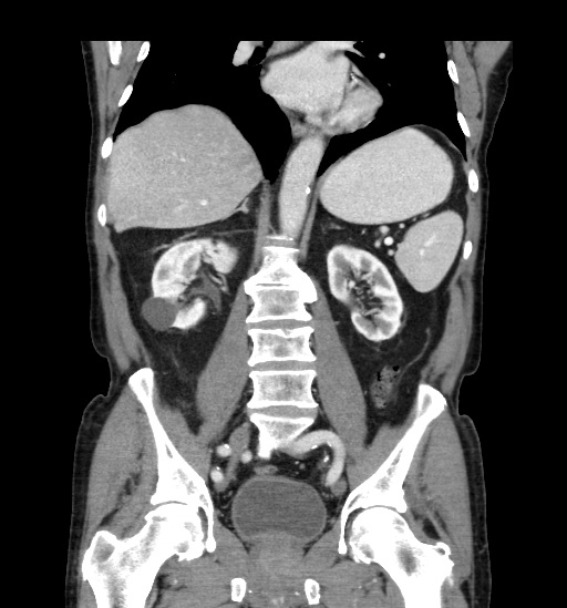 Appendicitis with localized perforation and abscess formation (Radiopaedia 49035-54130 B 30).jpg