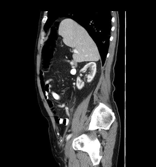 Appendicitis with localized perforation and abscess formation (Radiopaedia 49035-54130 C 20).jpg