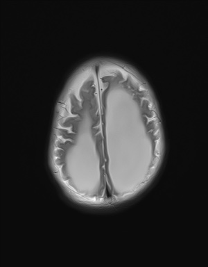 File:Aqueductal stenosis (Radiopaedia 73974-84802 Axial T2 19).jpg