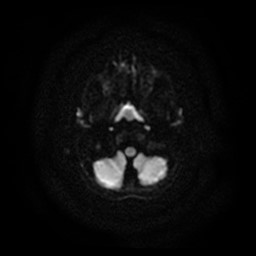 Arachnoid cyst - middle cranial fossa (Radiopaedia 86780-102938 Axial DWI 26).jpg