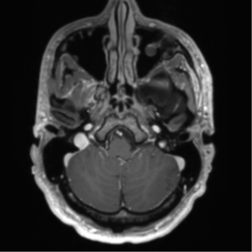 Arachnoid cyst with subdural hematoma (Radiopaedia 85892-101743 Axial T1 C+ 19).png