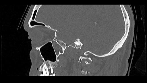File:Arcuate foramen (Radiopaedia 89833-106944 Sagittal bone window 103).jpg