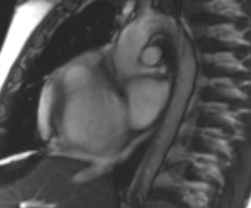 Arrhythmogenic right ventricular cardiomyopathy (Radiopaedia 69431-79307 Short axis cine 254).jpg