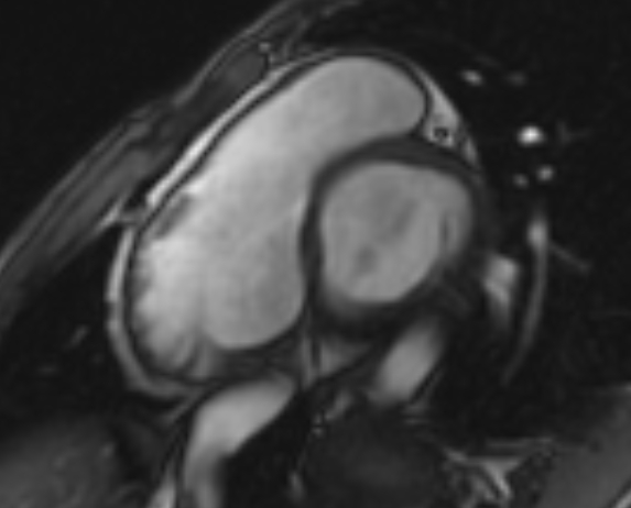 Arrhythmogenic right ventricular cardiomyopathy (Radiopaedia 69564-79464 short axis cine 237).jpg