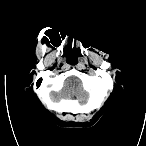File:Arteriovenous malformation (cerebral) (Radiopaedia 40070-42579 Axial non-contrast 5).png