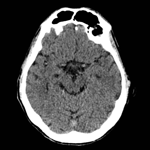 File:Artery of Percheron infarct (Radiopaedia 48088-52893 Axial non-contrast 16).jpg
