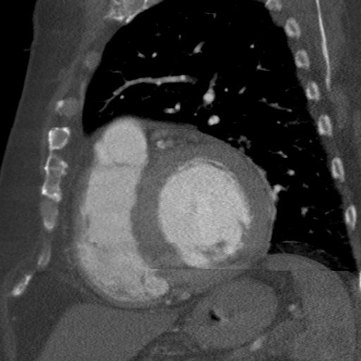 File:Ascending aortic aneurysm (Radiopaedia 20913-20846 A 5).jpg