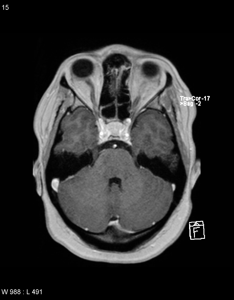 Astroblastoma (Radiopaedia 39792-42217 Axial T1 C+ 14).jpg