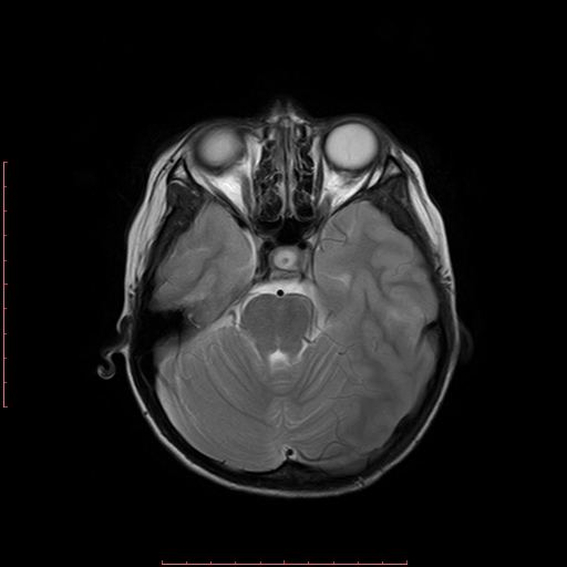 File:Astroblastoma (Radiopaedia 74287-85162 Axial T2 6).jpg