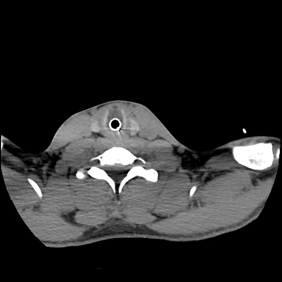 File:Atlanto-occipital dissociation (Traynelis type 1), C2 teardrop fracture, C6-7 facet joint dislocation (Radiopaedia 87655-104061 Axial non-contrast 70).jpg