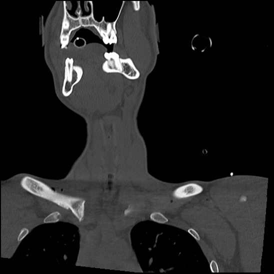 Atlanto-occipital dissociation (Traynelis type 1), C2 teardrop fracture, C6-7 facet joint dislocation (Radiopaedia 87655-104061 Coronal bone window 14).jpg