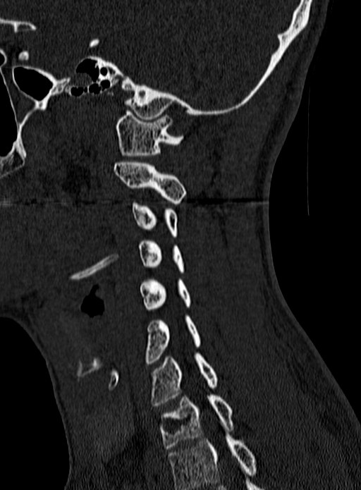 Atlantoaxial subluxation (Radiopaedia 44681-48450 Sagittal bone window 117).jpg