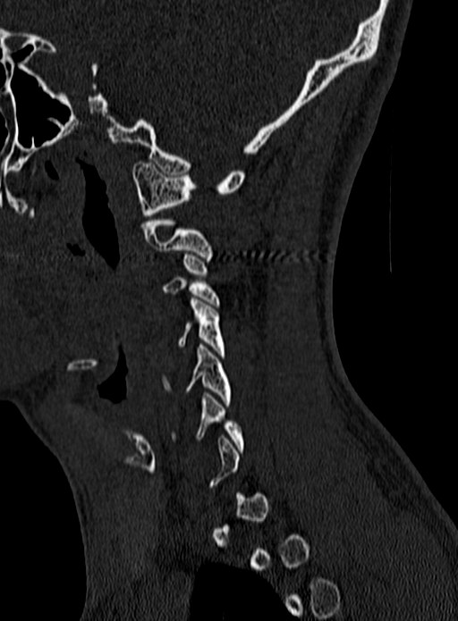 Atlantoaxial subluxation (Radiopaedia 44681-48450 Sagittal bone window 5).jpg