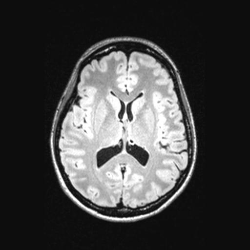 Atretic encephalocoele with inferior vermis hypoplasia (Radiopaedia 30443-31108 Axial 89).jpg