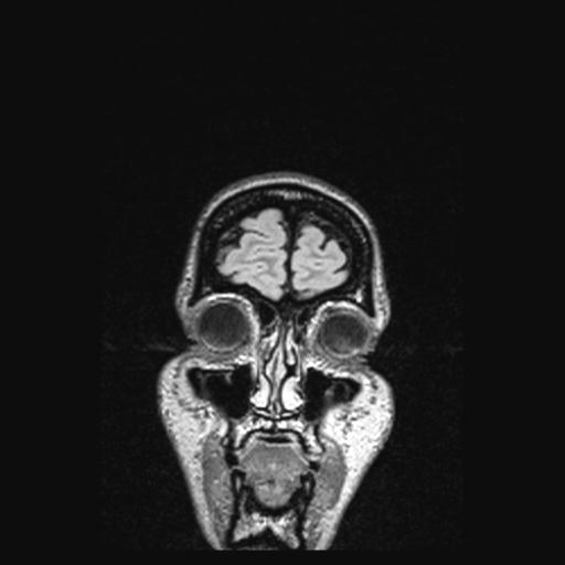 Atretic encephalocoele with inferior vermis hypoplasia (Radiopaedia 30443-31108 Coronal FLAIR 166).jpg