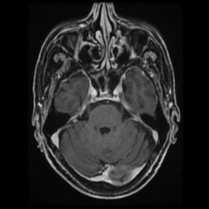 Atypical meningioma (Radiopaedia 45535-49629 Axial T1 C+ 27).jpg