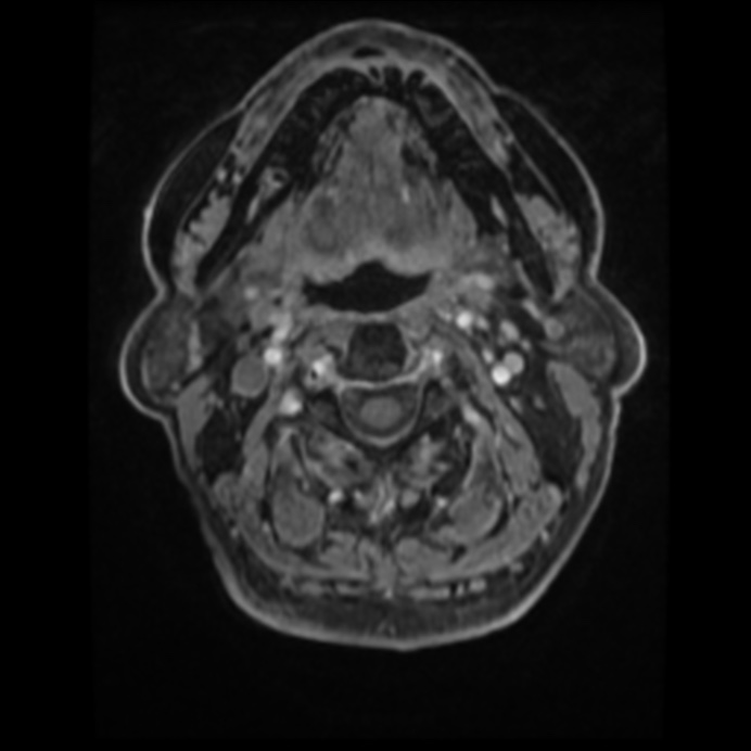 Atypical meningioma (Radiopaedia 45535-49629 Axial T1 C+ 5).jpg