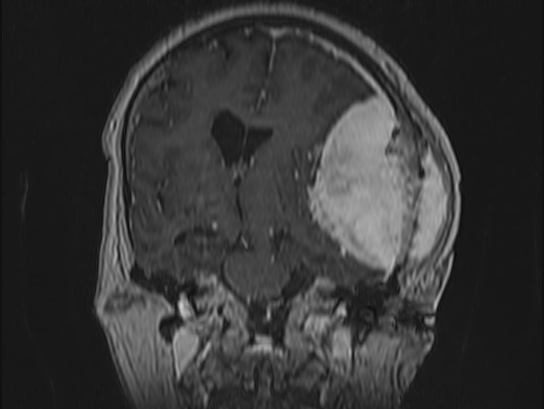 Atypical meningioma (Radiopaedia 62985-71406 Coronal T1 C+ 58).jpg