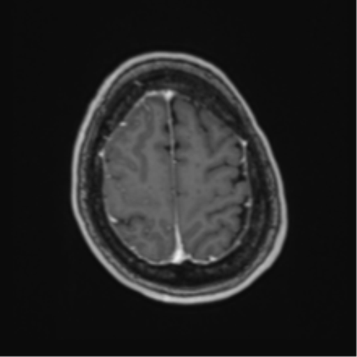 Atypical meningioma (WHO Grade II) (Radiopaedia 54742-60981 Axial T1 C+ 59).png