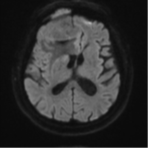 Atypical meningioma (WHO grade II) with brain invasion (Radiopaedia 57767-64729 Axial DWI 46).png
