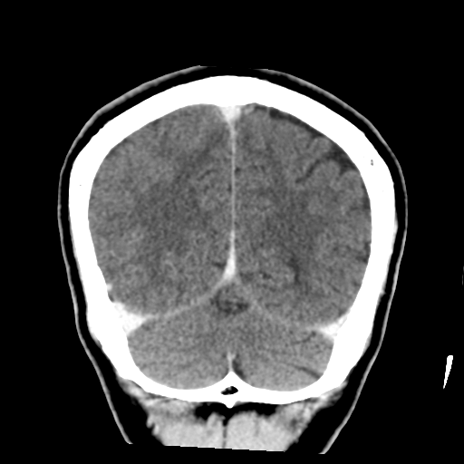 Atypical meningioma with skull invasion (Radiopaedia 34357-35649 Coronal C+ delayed 47).png