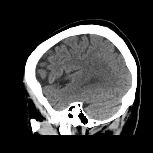 Atypical meningioma with skull invasion (Radiopaedia 34357-35649 E 42).png