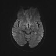 File:Autoimmune limbic encephalitis (Radiopaedia 30363-31005 Axial B0 and DWI 46).jpg