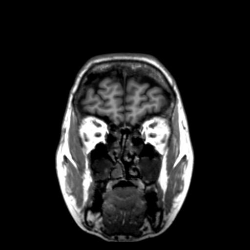 Autoimmune limbic encephalitis (Radiopaedia 30363-31005 Coronal T1 48).jpg