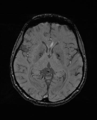 Autoimmune limbic encephalitis (Radiopaedia 30363-31005 SWI - magnitude 38).jpg
