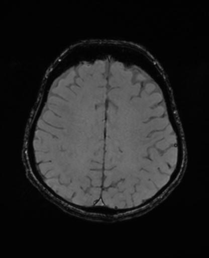 File:Autoimmune limbic encephalitis (Radiopaedia 30363-31005 SWI - magnitude 55).jpg