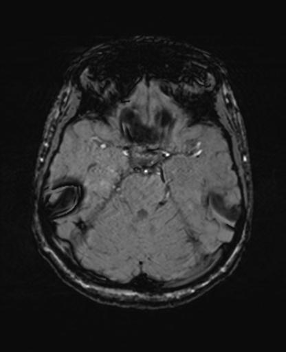 Autoimmune limbic encephalitis (Radiopaedia 30363-31005 SWI 26).jpg