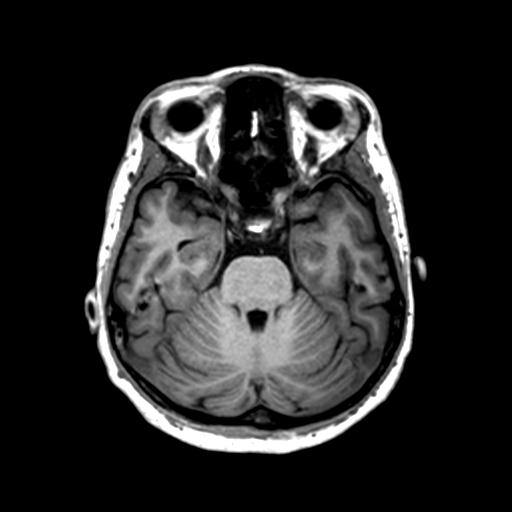 Autoimmune limbic encephalitis (Radiopaedia 30363-31005 T1 Axial 1mm 52).jpg