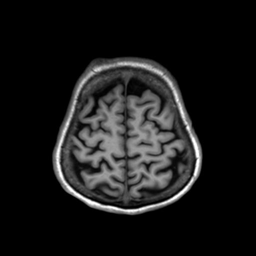 Autoimmune limbic encephalitis (Radiopaedia 30363-31005 T1 Axial 3mm 42).jpg