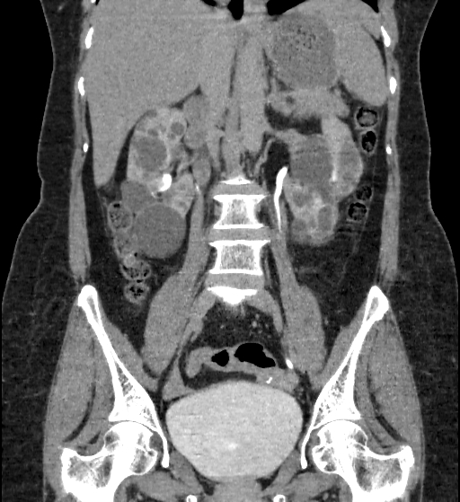 Autosomal dominant polycystic kidney disease (Radiopaedia 38189-40194 Coronal C+ delayed 49).jpg