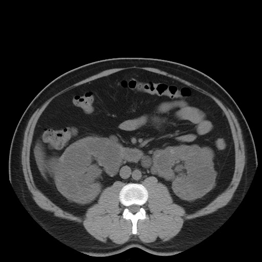 File:Autosomal dominant polycystic kidney disease (Radiopaedia 50259-55612 Axial non-contrast 42).jpg