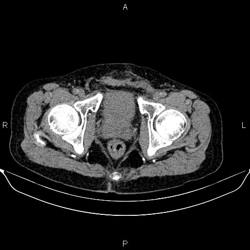Autosomal dominant polycystic kidney disease (Radiopaedia 87830-104287 Axial non-contrast 54).jpg